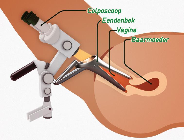 5.6 Bijkomend onderzoek Mogelijkheden bij een afwijkend uitstrijkje: een lichamelijk onderzoek: de gynaecoloog onderzoekt de baarmoeder zowel uitwendig als inwendig (via de vagina).