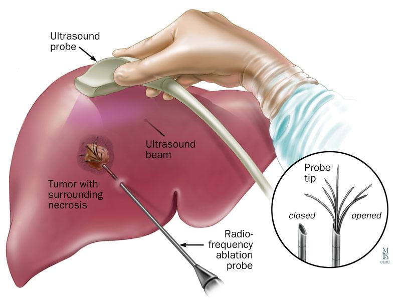 Barcelona Clinic Liver Cancer (BCLC) Bruix et al.