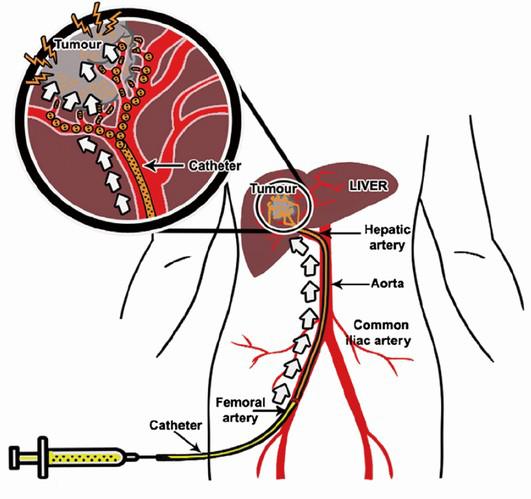 Barcelona Clinic Liver Cancer (BCLC) Bruix et al. Gastroenterology.