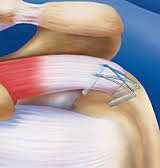 In een groot deel van de gevallen gaat het om een scheur in de pees van een van de schouderspieren (rotator cuff).