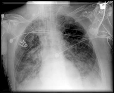 Long protectief beademen bij ARDS Plateau pressure <30 cm H₂O; driving pressure <15 cm H₂O Voldoende PEEP FiO₂ zo laag mogelijk 6 ml/kg PBW (of lager) Gevolg is vaak hypercapnie *The Acute