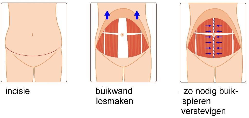 De littekens van een buikwandcorrectie lopen rond de navel en grotendeels binnen de 'bikinilijn.