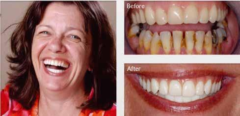 UITNEEMBARE GEBITSPROTHESEN Voor diegenen die hun tanden willen vervangen, zijn uitneembare kunstgebitten een gebruikelijke oplossing.