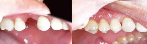 NIET-TERMINALE OPLOSSINGEN KRONEN / BRUGGEN Tandheelkundige kronen en bruggen zijn gebruikelijke tandheelkundige procedures die afgebroken of ontbrekende tanden kunnen versterken en/of vervangen.