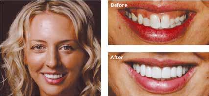 INLAYS / ONLAYS Inlays en onlays zijn reconstructieve procedures die worden gebruikt om gebroken of beschadigde tanden te herstellen.