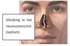 Neusoperaties Neusseptumcorrectie Hierbij wordt alleen geopereerd in het inwendige van de neus; er zijn dus geen zichtbare littekens te verwachten.
