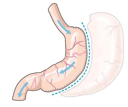 Gastric sleeve Bij een gastric sleeve wordt een deel van de maag verwijderd. Er wordt enkel een kleine maag gemaakt zonder aanpassingen aan de darm.