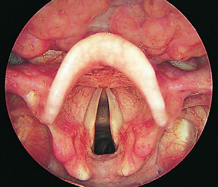 Epiglottis Voorste commissuur van de stemplooien Pars intermembranacea Pars intercartilaginea Plica