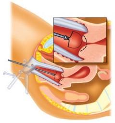 Behandeling van CIN 2 en CIN 3 Afwijkend weefsel van de baarmoederhals De uitslag: een CIN-afwijking Recent is uw baarmoederhals onderzocht door middel van een kolposcopie.