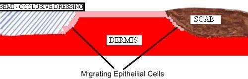 Vochtige Wondheling In moist wounds the epithelialization goes 2-3 times quicker in comparison in wounds that are kept dry, air exposed.
