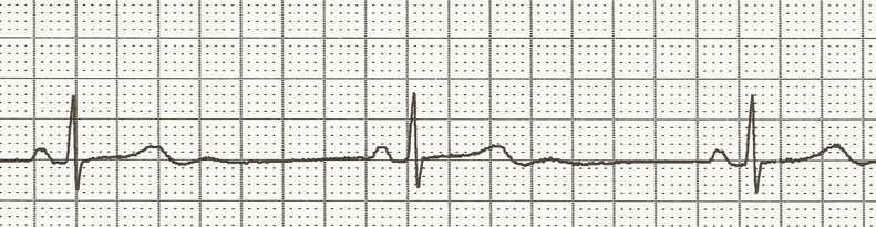 ECG bij cardiogene syncope: basisritme <40/min
