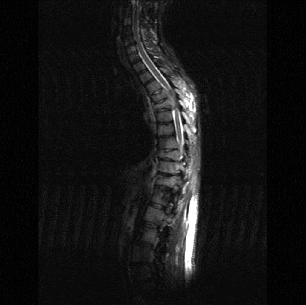 Oorzaken perifere neuropathie Paraproteïne: Multiple Myeloom Ziekte gerelateerd: Mechanisch spinal cord compression