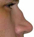 Is je neus ernstig verstopt door de korstvorming, dan werkt deze neusdouche waarschijnlijk niet.