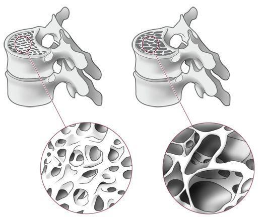 Osteoporose Osteoporose betekent letterlijk poreus bot of bot met gaten en wordt ook wel botontkalking genoemd.