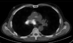 All patients will receive cisplatin, 80 mg/m2 on day 1 and etoposide, 100 mg/m2 on days 1, 2, and 3, every 21 days for four cycles.! Murray, J Clin Oncol. 1993;11(2):336.! Fried, J Clin Oncol.