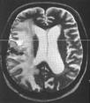 best binnen 4 wk na de laatste chemotherapie toediening (niet cyclus) acuut:! haaruitval, erytheem scalp, vermoeidheid, craniale overdruk laat:! neurotoxiciteit:! cognitieve dysfunctie,!