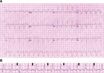 LEWIS ECG DOEIS-EEN-LEWIS Zichtbaar maken van atriale activiteit In dit artikel bespreekt de auteur de diagnostische waarde van een Lewis-ECG.