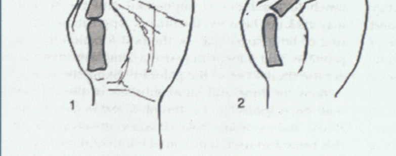 et al. A dynamic approach to the thumb-in-palm deformity in cerebral palsy.