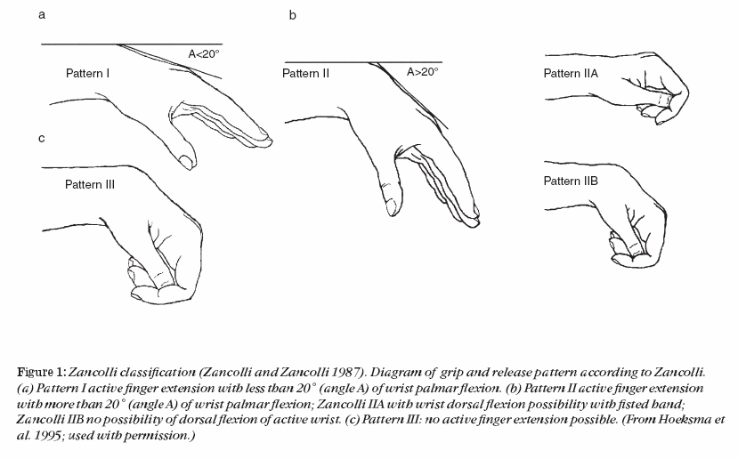 Figuur 3.2. Zancolli classificatie voor de pols (Zancolli 1987) (Met toestemmig overgenomen uit: Hoeksma AF, et al. Operatieve mogelijkheden bij spastisch verlamde arm en hand.