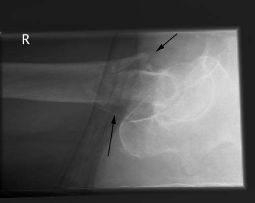 2 Röntgendiagnostiek Routine röntgenonderzoek van de heup houdt in: AP röntgenopname van het bekken en axiale röntgenopname van de zijde, waar de fractuur vermoed wordt.