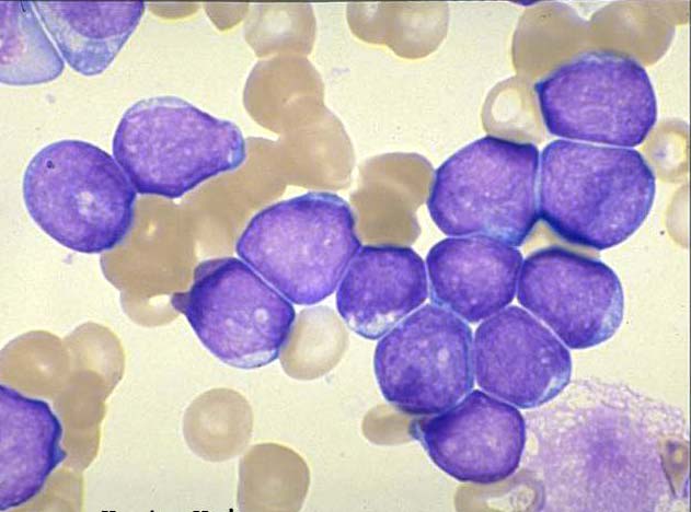 Leukemie