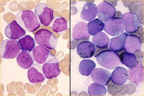 AML M1 (FAB) Acute myeloblastische leukemie zonder maturatie 90% blasten (op NEC) 3% MPO + Mature componenten (monocytengranulocyten) 10% (op NEC) -