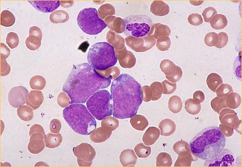 AML M2 (FAB) Acute myeloblastische leukemie met maturatie 30-89% blasten (op NEC) Granulocytaire component > 10% (op NEC) Monocytaire component 20% (op NEC) (geen andere criteria van M4!