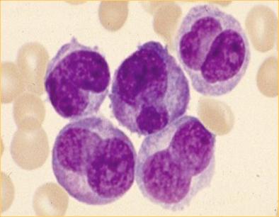 AML M3 variant (FAB) = Hypogranulaire vorm verhoogd aantal WBC met meer abnormale vormen in perifeer bloed promyelocyten: agranulair of fijne, stofachtige rode granules, (bundels