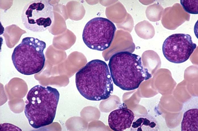 ALL L3 (FAB) = leukemische presentatie Burkitt s lymfoom Endemisch (tropisch Afrika en Nieuw- Guinea) tumor wang Sporadisch (alle leeftijden!