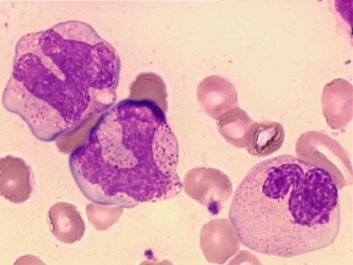 AML met t(8;21)(q22;q22) AML: 5-12 %, AML M2: 30 % typische morfologische kenmerken heterogene