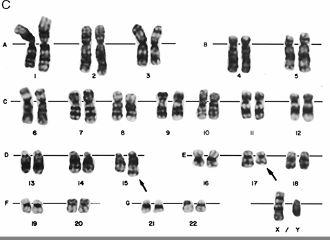 Promyelocyten leukemie met t(15;17) (q21;q12) 5-8 % van