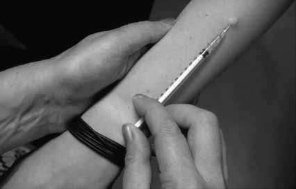 Een tuberculinehuidtest Foto: ITSC Tuberculinehuidtest (mantouxtest) De tuberculinehuidtest is een huidprikje waarbij een kleine hoeveelheid testvloeistof in de huid van de onderarm wordt gespoten.