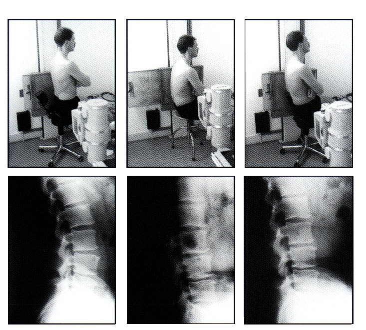 Fig. 17 Röntgen-opnamen tijdens actief-/ gecorrigeerd passief-/ passief zitten. actief passief gesteund/gecorrigeerd passief Litteratuur referenties: Orthopedic Me