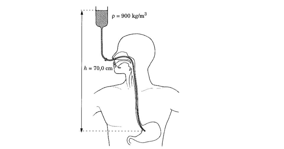 dr. Brenda Casteleyn www.keu6.be Page 7 2000 - Juli Vraag 6 Bij kunstmatige voeding gebruikt men een katheter (een kunststo f slangetje), die langs de neus in de maag gebracht wordt.