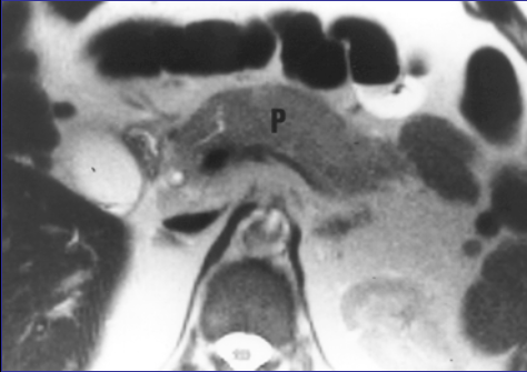 Casus 3: Man, 71 jaar NMR pancreas T1: