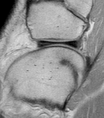 Figuur 2: Ontstaan van een degeneratieve afwijking op follow-up MRI bij een patiënt na distorsie van de rechterknie. a) Op de initiële MRI is een normale voorhoorn van de laterale meniscus te zien.