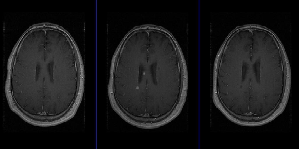 MRI opnames Dit zijn drie plaatjes van dezelfde patiënt op verschillende tijdstippen.