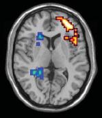 CBD onderzoek: neuroimaging Tegengestelde effecten van en CBD op hersenfunctie Prefrontale cortex Effecten vs CBD CBD onderzoek: klinische trials CBD aan patiënten met psychotische stoornis: