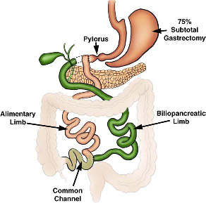 onmiddellijk overgaat in de darm. De symptomen van het dumpingsyndroom zijn zweten, abdominale krampen, een licht gevoel in het hoofd en diarree (Schneider, 2000). 3.1.