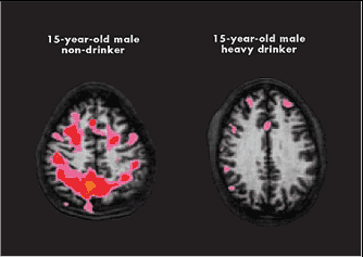 Hersenschade fmri van twee 15 jarige jongens (op moment van MRI zijn beiden nuchter).
