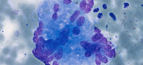 M. Veselic Normal lymphnode Small fragment of tissue with carbon pigment and small mature lymphocytes In background few squamous cells No granulomas No tumor