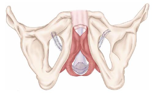 Sling voor mannen (male sling) + eenvoudige ingreep + Implantaat hoeft niet te worden geactiveerd - niet altijd vergoed!