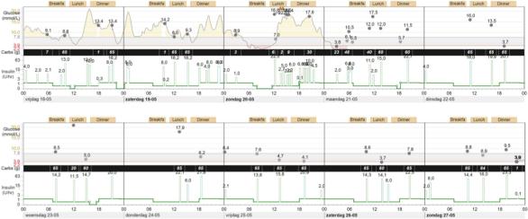 14 dagen CGM Basaal-bolus: 25-75% TDI: 88 E Slechts 7 van de 14 dagen CGM. Nog veel manual bolusses naast BW Adequate naald vervanging?