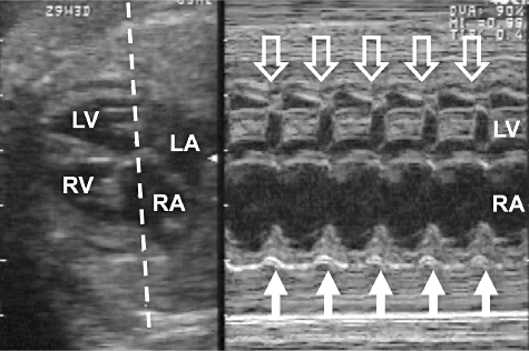 snel ritme frequentie neonataal/foetaal +- 250, minder op oudere leeftijd plots begin en plots einde Supraventricular tachycardia : atrio-ventricular re-entry tachycardia with accessory pathway