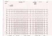 ontslagbrief Atrial ectopic tachycardia Elise werd quasi a term geboren via semi-urgente