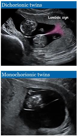 Meerlingen Toepassing van de combinatietest in meerlingzwangerschappen vereist aanpassing van de biochemische MoM waarden.