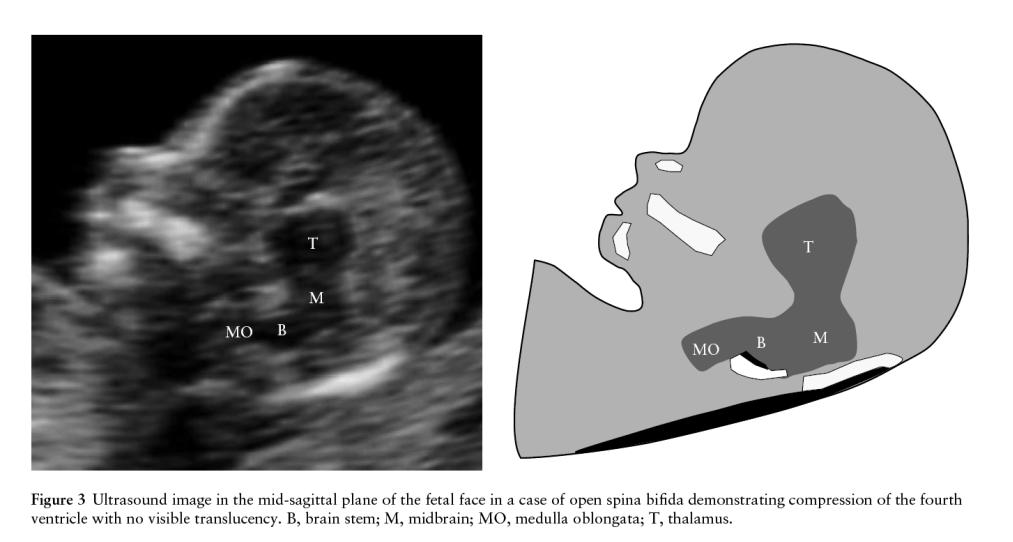 Spina bifida bij 11-13 +6 weken Normaal 4 e ventrikel