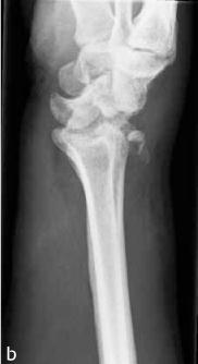 post-traumatisch etiologie distale radius fractuur scaphoid fractuur (SNAC wrist) perilunatire