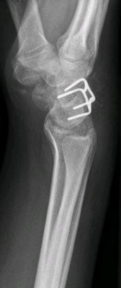 SNAC/SLAC Wrist Proximale rijcarpectomie LCTH artrodese voordeel: ROM nadeel: verandering