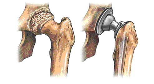 Een normaal heupgewricht Bij een normaal heupgewricht zit de ronde kop van het dijbeen in een holle gewrichtskom, die wordt gevormd door de bekkenbeenderen.